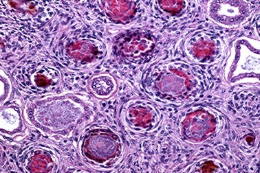  Bệnh sốt mò “rình” người đi phượt 