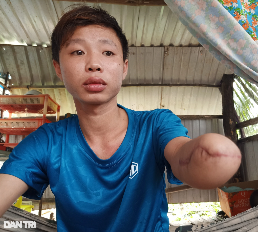 Bị tai nạn, chàng trai hiếu thảo mong có tiền lắp tay giả, phụ mẹ nuôi em - 2 Bị tai nạn, chàng trai hiếu thảo mong có tiền lắp tay giả, phụ mẹ nuôi em - 2