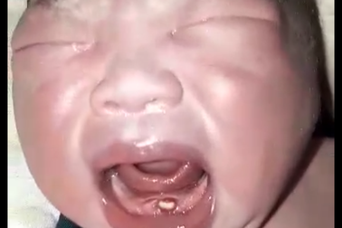 Bé trai vừa chào đời đã mọc răng