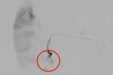 Chàng trai 24 tuổi vỡ thận độ 4 nguy kịch vì... một con bò