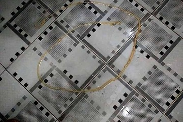 Kinh hãi sán xơ mít dài hơn 2m trong bụng bệnh nhân