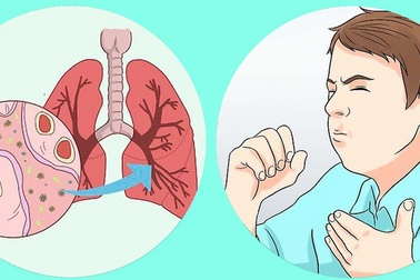 Bảo Phế Vương - Giải pháp cho người bị ho, khó thở do các bệnh viêm đường hô hấp gây ra