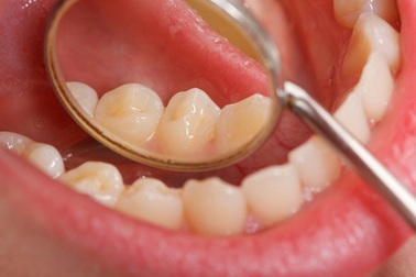 Có đặc điểm này bạn dễ mắc ung thư khoang miệng