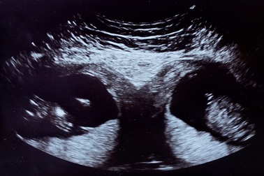 Người phụ nữ mang song thai ở 2 tử cung