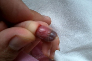 Bé nhũ nhi hoại tử ngón tay vì cọng chỉ