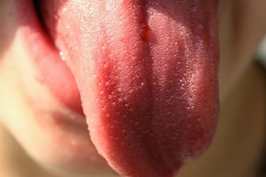 Cảnh báo về sự nguy hiểm khi xuất hiện những vết sưng tấy trên lưỡi