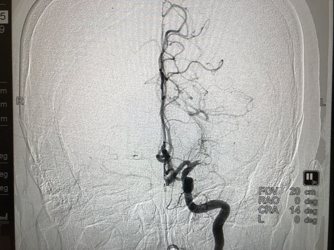 Đột quỵ thời Covid-19 - Đừng để lỡ mất giờ vàng - 4 Đột quỵ thời Covid-19 - Đừng để lỡ mất giờ vàng - 4