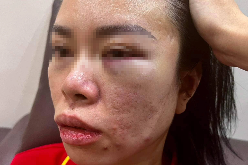Giám định thương tích người phụ nữ tố bị chồng cũ bắt giữ, đánh đập - 1 Giám định thương tích người phụ nữ tố bị chồng cũ bắt giữ, đánh đập - 1