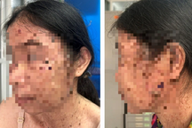 Bệnh nhân ngỡ ngàng phát hiện ung thư da vì chi chít "hạt cơm" trên người
