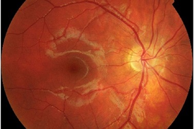 Phát triển mô hình để điều trị sớm bệnh thái hóa điểm vàng