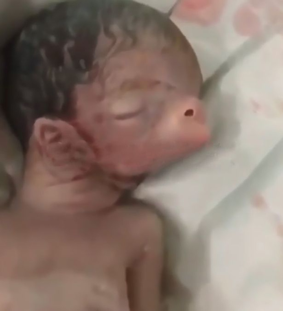 Em bé sinh ra với tai và mũi lợn - 1 Em bé sinh ra với tai và mũi lợn - 1