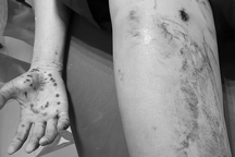 Vừa dùng vừa sạc, thiếu niên cấp cứu vì điện thoại phát nổ trên tay