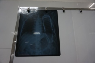 Thông tin tiếp vụ chai nước chui vào lồng ngực