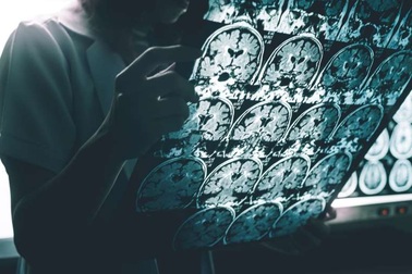 Dấu hiệu sớm của bệnh Alzheimer