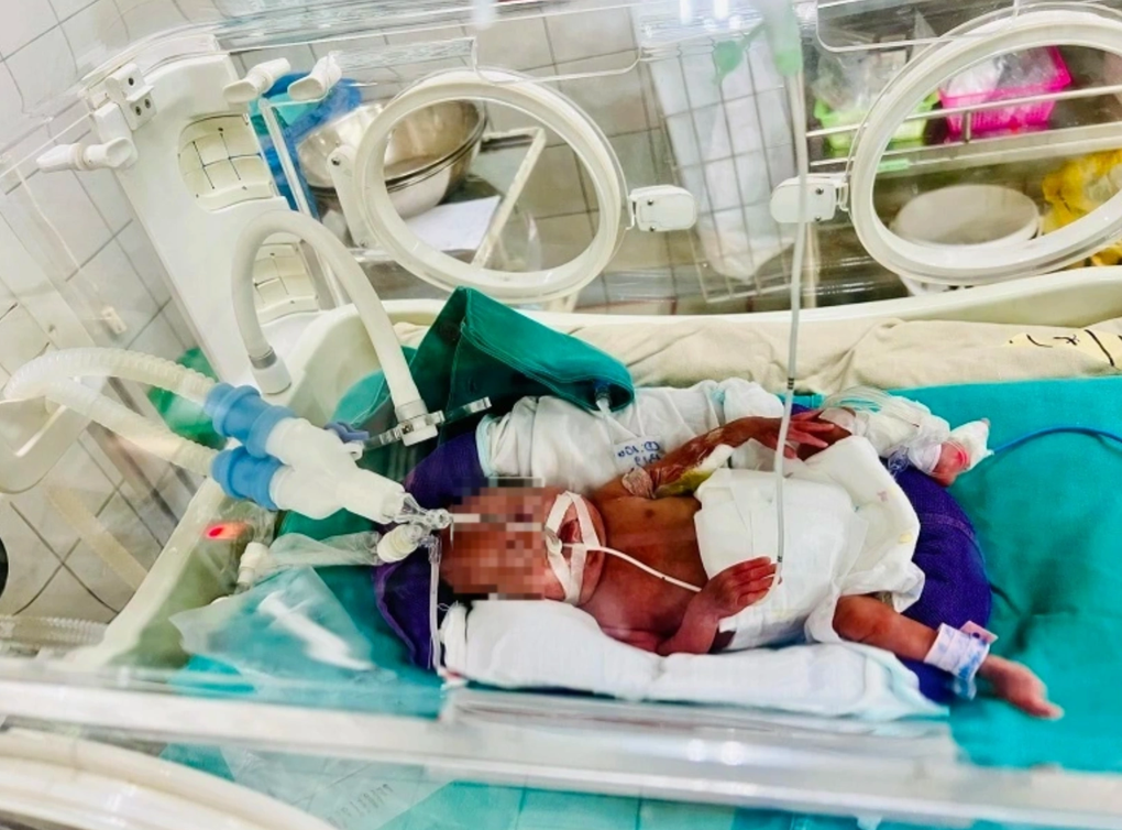 Bé sinh non 400g phát triển như thế nào sau một năm? - 1 Bé sinh non 400g phát triển như thế nào sau một năm? - 1