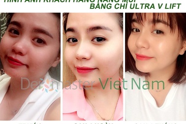 Sở hữu mũi cao thanh thoát một cách dễ dàng