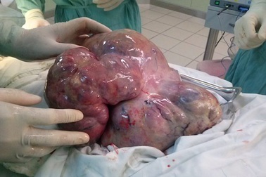 Thiếu nữ mang khối u buồng trứng nặng gần 4kg