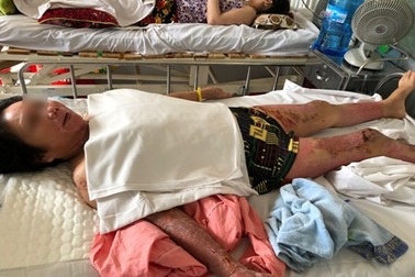Bỏng nặng toàn thân sau 2 lần bị chồng hờ tạt a xít