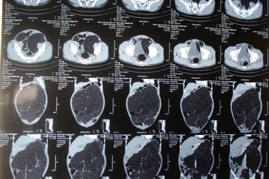 Đi khám đau bụng, phát hiện u khủng lớn hơn 10kg