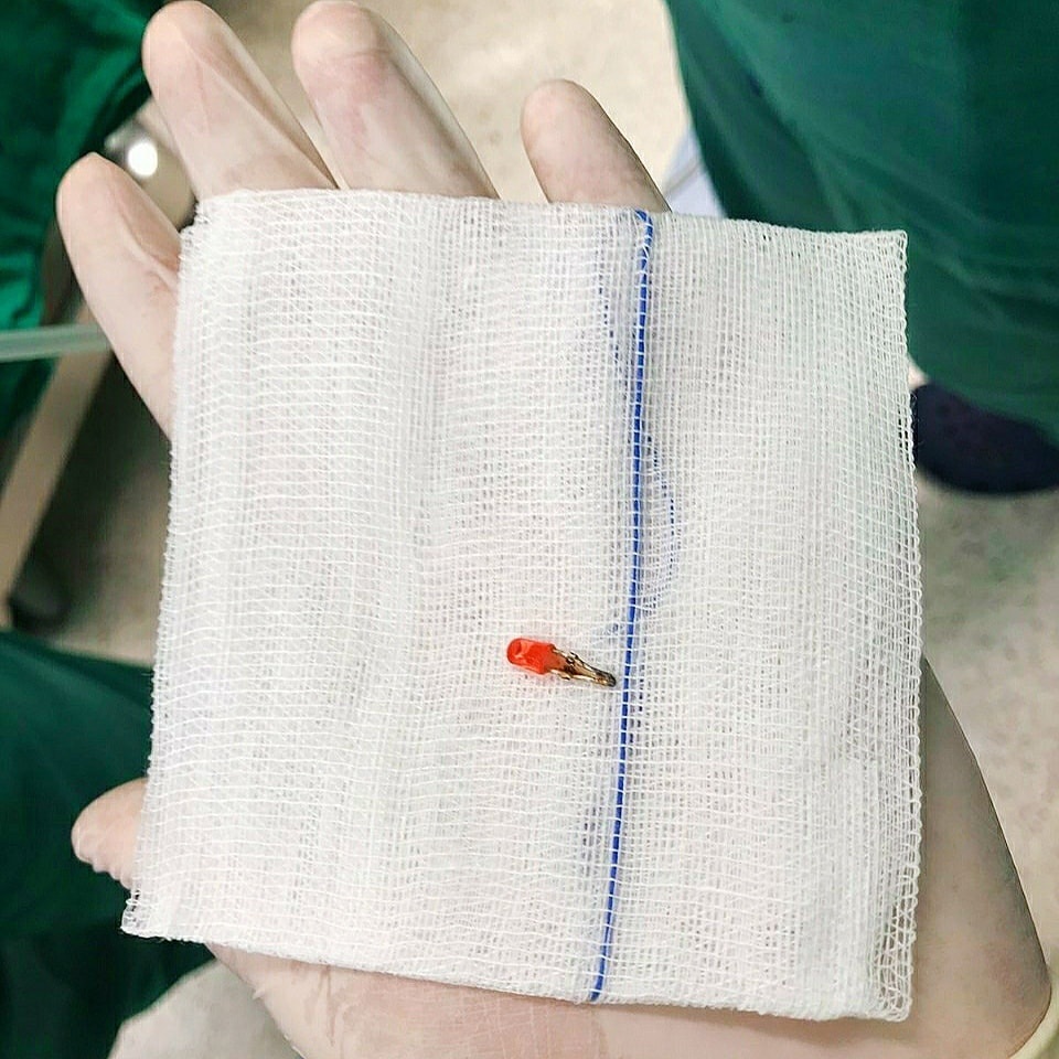 Bóng đèn nhựa nằm trong phổi bé gái 10 tháng tuổi - 3 Bóng đèn nhựa nằm trong phổi bé gái 10 tháng tuổi - 3
