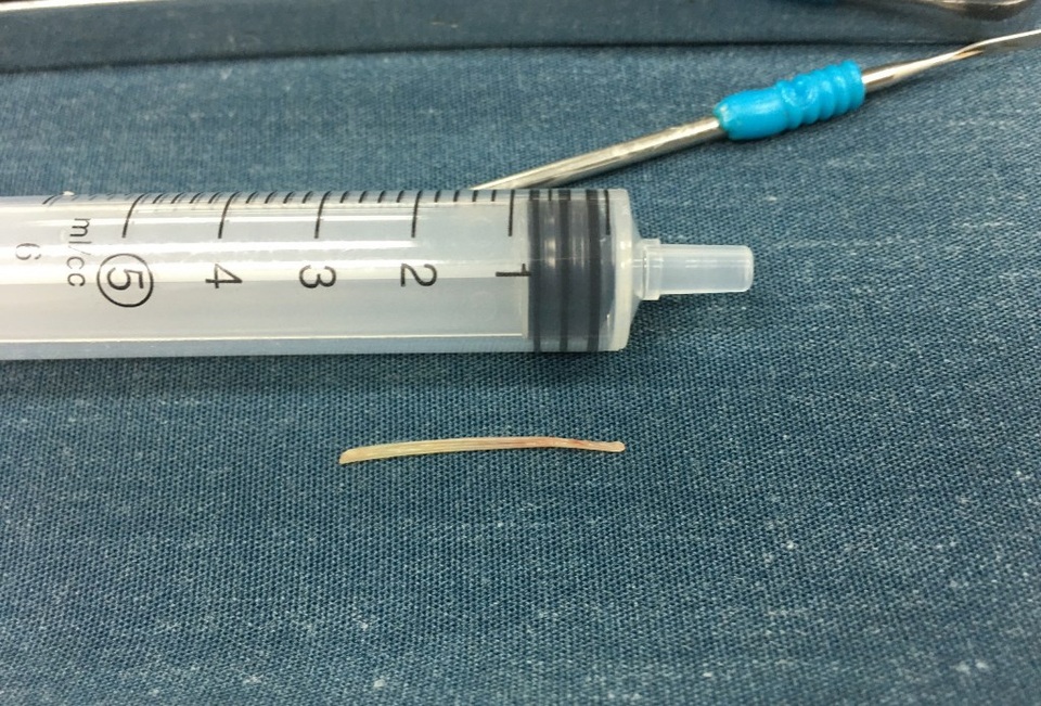Mắc xương cá điều trị theo phương pháp dân gian, bé gái bị sưng vùng cổ - 2 Mắc xương cá điều trị theo phương pháp dân gian, bé gái bị sưng vùng cổ - 2