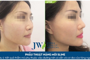 Giải pháp nào cho người đã phẫu thuật mũi hỏng?