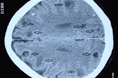 Phát hiện gần 50 ổ sán trong não bệnh nhân