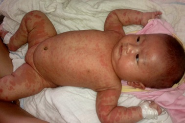 Bé 3 tháng tuổi nổi mẩn đỏ khắp người sau khi tiêm vắc xin