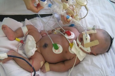 Bé trai sơ sinh cô độc chống chọi bệnh uốn ván