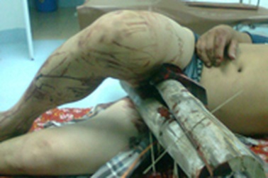 Bệnh viện Hà Tĩnh: Thành công ca mổ khó nhất từ trước tới nay 