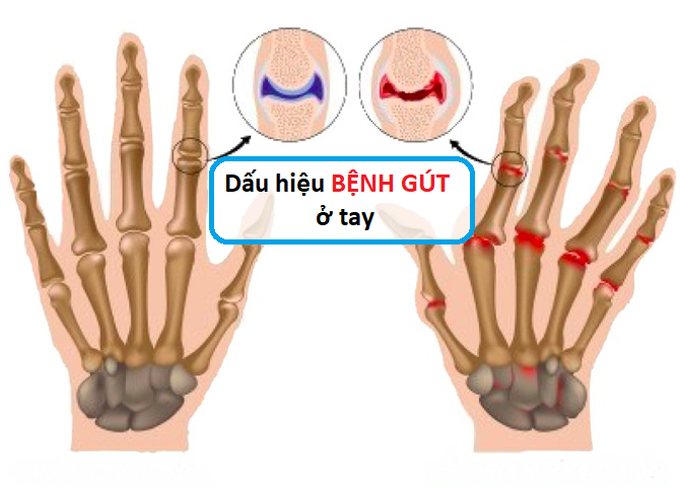 Bác sĩ mách triệu chứng ban đầu và cách điều trị bệnh Gút - Ảnh 2. Bác sĩ mách triệu chứng ban đầu và cách điều trị bệnh Gút - Ảnh 2.