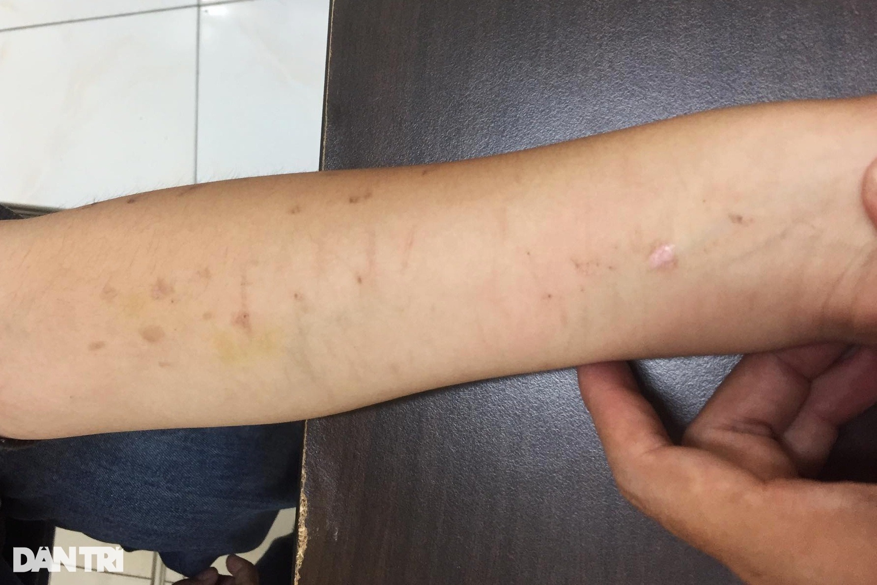 Cánh tay đầy vết rạch dao lam và chuyện những người trẻ bị trầm cảm hành hạ - 1 Cánh tay đầy vết rạch dao lam và chuyện những người trẻ bị trầm cảm hành hạ - 1