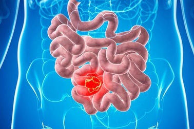 Đột phá trong điều trị ung thư ruột