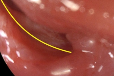 Nuốt thanh kiếm dài hơn 40cm, nam thanh niên bị đâm thủng thực quản