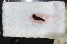 Con vắt dài 4cm, to bằng đầu đũa sống trong mũi người đàn ông