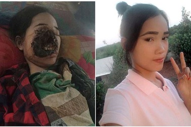 Kinh hoàng biến chứng “không mặt” sau nhổ răng