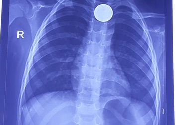 Sau tiếng khóc thét, đồng xu trôi tọt vào thực quản bé trai 3 tuổi