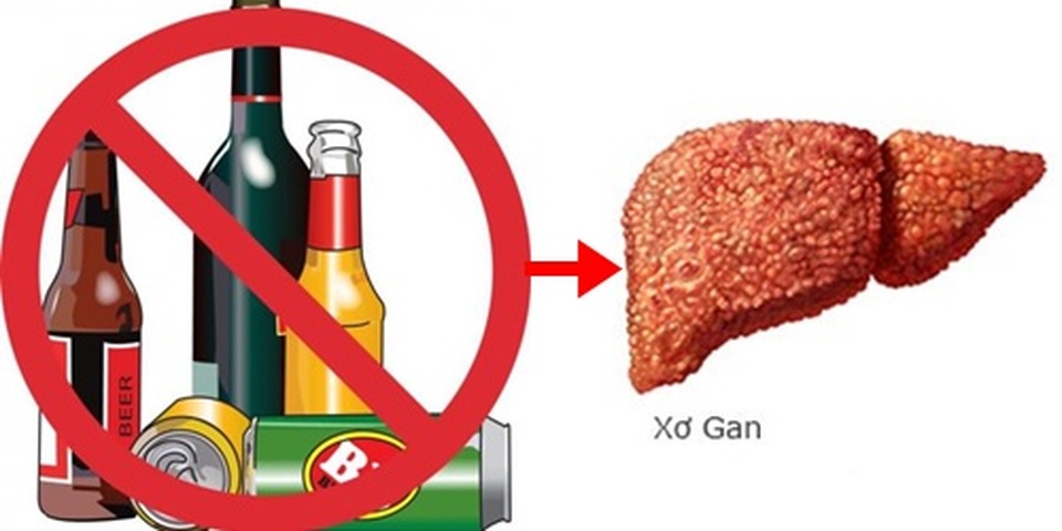 Phát triển thuốc điều trị xơ gan do rượu - 1 Phát triển thuốc điều trị xơ gan do rượu - 1