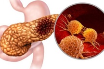 Các triệu chứng của ung thư tụy