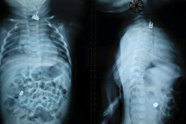 Anh 2 tuổi cho “ăn” công tắc đèn, bé 3 tháng tuổi suýt tử vong