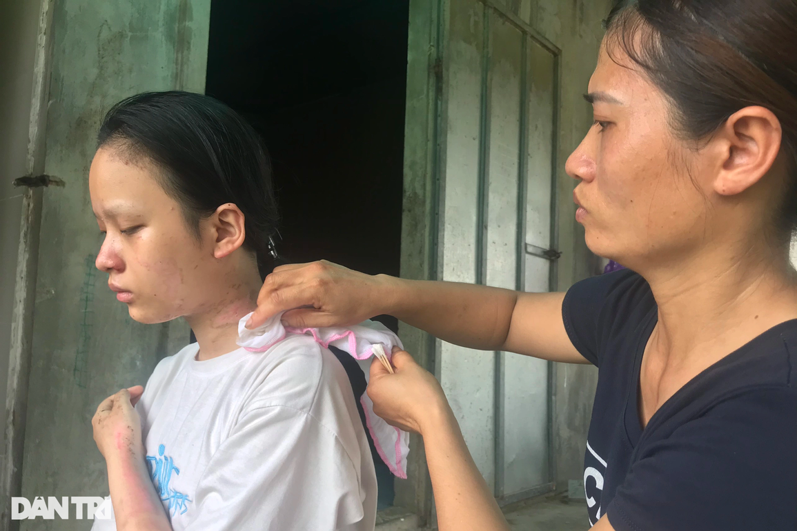 Cơ cực gia đình nghèo và tai họa đổ ập xuống 3 con nhỏ bị bỏng nặng - 8 Cơ cực gia đình nghèo và tai họa đổ ập xuống 3 con nhỏ bị bỏng nặng - 8