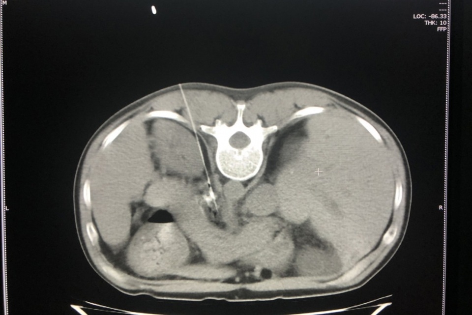 Giảm đau cho bệnh nhân ung thư gan giai đoạn cuối - 1 Giảm đau cho bệnh nhân ung thư gan giai đoạn cuối - 1