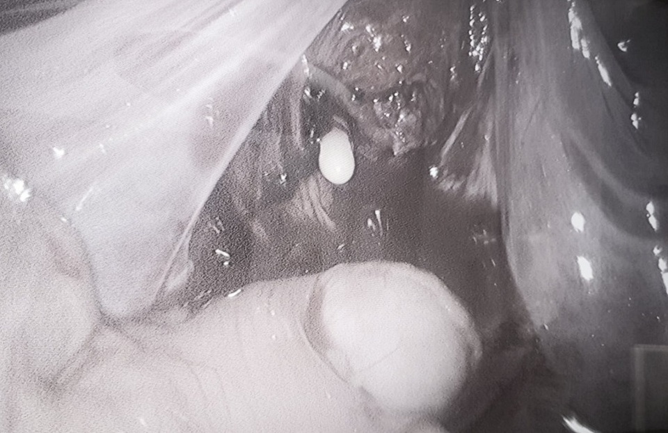 Cha mẹ cho ngồi trước xe, cậu bé lòi ruột sau tai nạn - 1