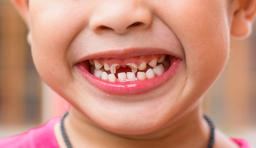 Midkid - giải pháp mới giúp chăm sóc hàm răng xinh của trẻ - 1 Midkid - giải pháp mới giúp chăm sóc hàm răng xinh của trẻ - 1