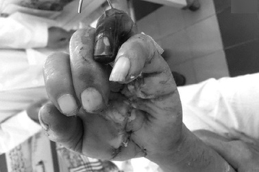 Thợ mộc bị máy cưa cắt lìa bàn tay