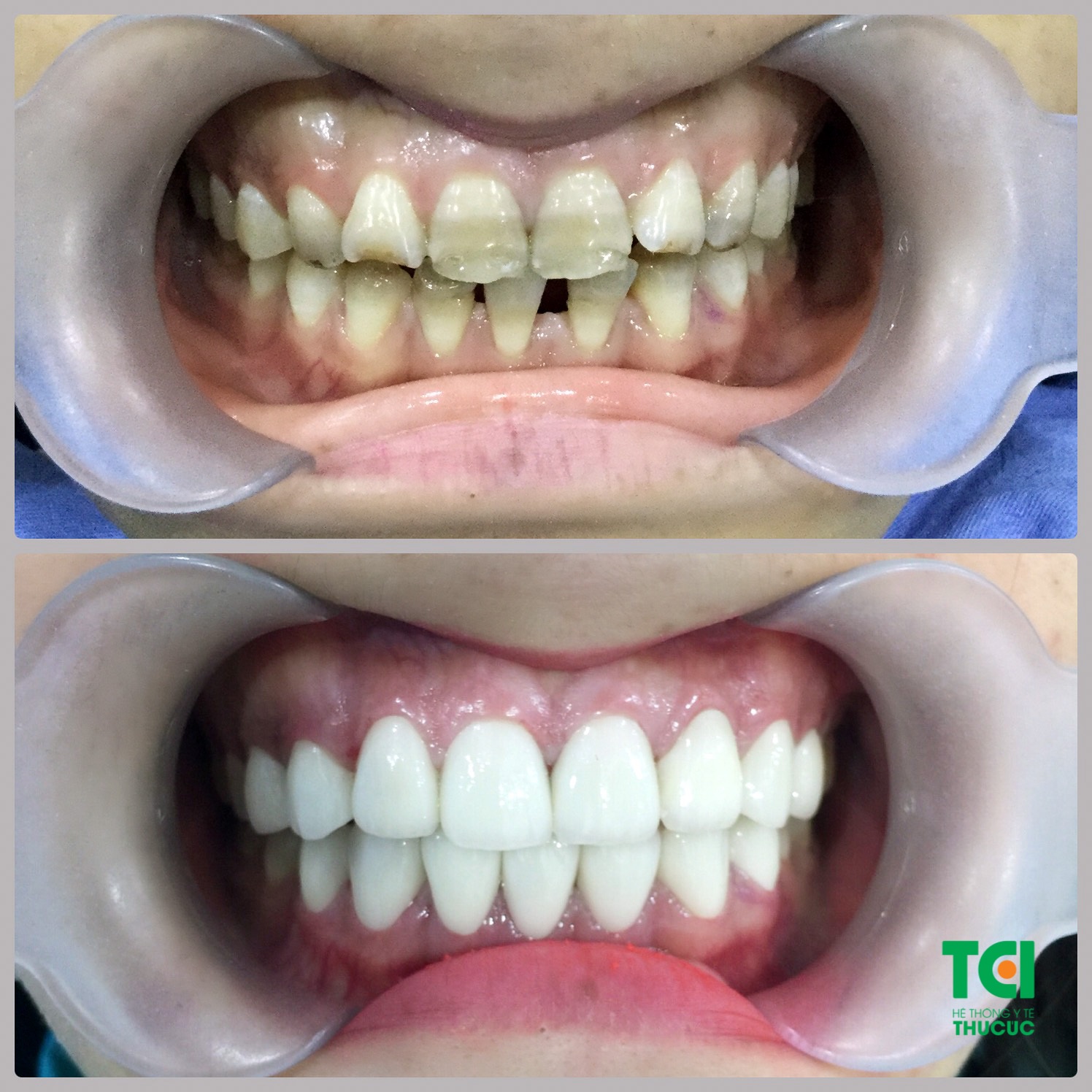 Giải pháp cho răng nhiễm Tetracycline - 2