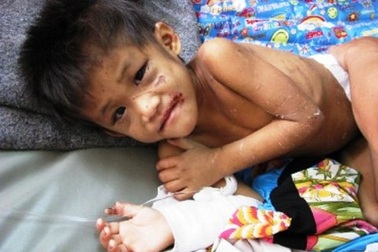 Gặp lại bé gái bất hạnh bị mẹ cắt gân tay, chân