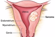 Sarcoma tử cung: Triệu chứng và dấu hiệu nhận biết
