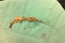 Một thanh niên bị tôm sống chui vào phế quản 