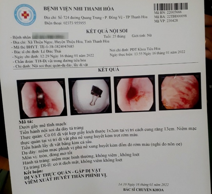 Hình ảnh kẹp giấy qua kết quả nội soi